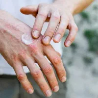 رفع اگزما/پیسی/پسوریازیس