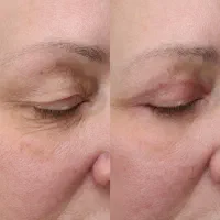 تخفیف ویژه پاییزی بلفارو پلاستی در اقدسیه