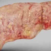 کبدتو نجات بده