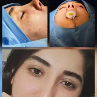 عمل زیبایی بینی فقط با ۳۱ میلیون