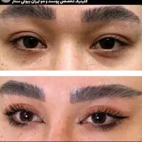 بلفارو / کاشت ابرو/ رفع غبغب/تزریق چربی