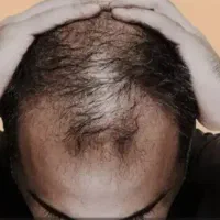 درمان طبیعی ریزش مو تقویت ریشه