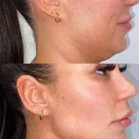 جشنواره ی پاییزه ژل ،بوتاکس،مزو|خدمات آرایشگری و زیبایی|شاهین‌شهر, فردوسی|دیوار