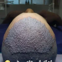 کاشت مو تارِنو|خدمات آرایشگری و زیبایی|خرم‌آباد, |دیوار