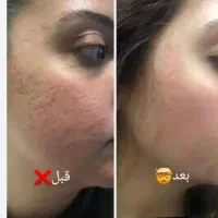 لیزر(خانم ها)۳۰۰لیزر(آقایان )۶۰۰و لیزر فوتونا۱۲۰۰|خدمات آرایشگری و زیبایی|نجفآباد, باغ ملی|دیوار