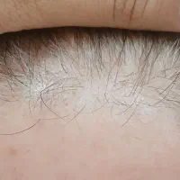 هیرفیلر مو دکتر CYJ|خدمات آرایشگری و زیبایی|تهران, تهرانسر غربی|دیوار