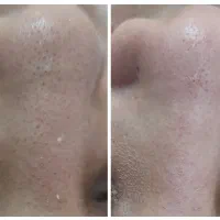 پاکسازی تخصصی صورت|خدمات آرایشگری و زیبایی|محمدشهر, محمدشهر|دیوار