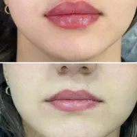 جشنواره تزریق ژل و بوتاکس|خدمات آرایشگری و زیبایی|اصفهان, دانشگاه اصفهان|دیوار