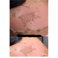 رفع تیرگی،آلگاپیل،لک صورت، پرسینگ، ژل صورت|خدمات آرایشگری و زیبایی|شیراز, سلطان آباد|دیوار