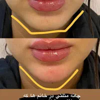 تخفیف ژل ،بوتاکس ،جوانساز،فیلر وفیشیال|خدمات آرایشگری و زیبایی|کرج, مهرویلا جنوبی|دیوار