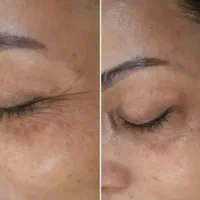 روتین پوستی،تپلی صورت،لک،جوش