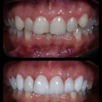 جشنواره کامپوزیت،لمینیت وبلیچینگ وخدمات دندانپزشکی