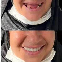 دندانسازی / دندان مصنوعی/ جوان پسند لمینتی/اقساط|خدمات آرایشگری و زیبایی|مشهد, عبادی|دیوار