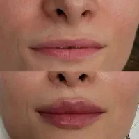بهترین خدمات زیبایی ژل بوتاکس فیلر مزوژل لیزر