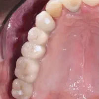 مرکزتخصصی ایمپلنت و دندانپزشکی بااقساط دوساله ووام|خدمات زیبایی و سلامت|تبریز, |دیوار