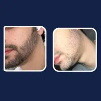 با کم پشتی ریشت خداحافظی کن