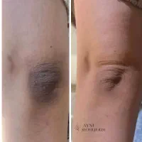 سفیدسازی پوست با تیرگی های بدنت خداحافظی کن
