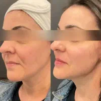 هایفوتراپی