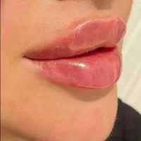 تزریق فیلر بادی و فول فیس،کاشت ابرو