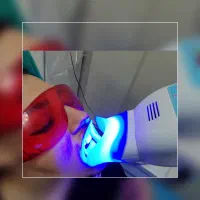 جرم گیری و بروساژ به همراه بلیچینگ ۴/۳۹۰T