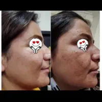 کرم سفیدکننده(آنتی استاین) ترکیب آمپولی|آرایشی، بهداشتی، درمانی|بم, |دیوار