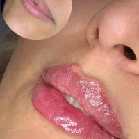 فیلر،بوتاکس،نخ،مزو،PRP