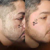 درمان اسکار ولک های قدیمی