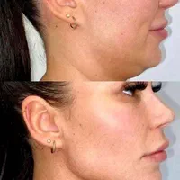 مدل برای هایفوتراپی فقط باقیمت استثنایی 950تومان