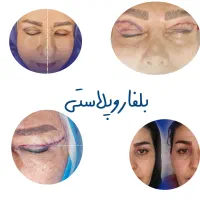 بلفاروپلاستی ، لیپو غبغب، تزریقات جوانساز|خدمات آرایشگری و زیبایی|تهران, دهم فروردین|دیوار