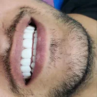 کامپوزیت فقط فکی ۱۶ تومن وآموزش  روز کامپوزیت|خدمات آرایشگری و زیبایی|تهران, شمشیری|دیوار