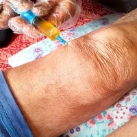 درمان آرتروز زانو/به روش پلاسما|خدمات آرایشگری و زیبایی|خرم‌آباد, |دیوار