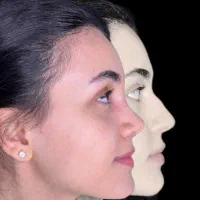 10 میلیون تخفیف عمل جراحی بینی بدون تامپون،لیفت|خدمات آرایشگری و زیبایی|فردیس, طالقانی|دیوار