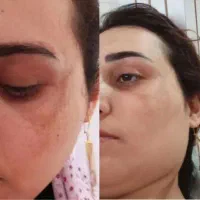لک های صورتتو از بین ببر