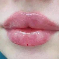 انجام خدمات ژل و بوتاکس|خدمات آرایشگری و زیبایی|اسلامشهر, شهرک مصطفی خمینی|دیوار