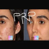 جشنواره تخفیف پی ار پی و بوتاکس