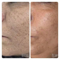 رفع لک ها و روشن سازی پوست|خدمات آرایشگری و زیبایی|اصفهان, مفتح|دیوار