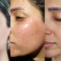 خال برداری،کراتین وپروتین وتزریق ژل و آموزش