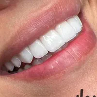 دندان مصنوعی|خدمات آرایشگری و زیبایی|اردبیل, |دیوار