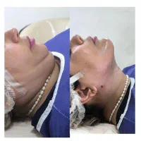 بلفاروپلاستی فقط با ۹ میلیون تومان در تهران|خدمات آرایشگری و زیبایی|باقرشهر, |دیوار