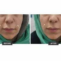خط خنده باعث شده چهره تان مسن تر دیده شود