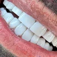 کامپوزیت دندان فکی ۵ ت اقساط لبه شیشه ای|خدمات آرایشگری و زیبایی|تهران, تهرانپارس جنوبی|دیوار