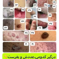 زگیل تناسلی و تبخال