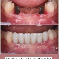 دندانپزشکی و شرایط اقساطی بدون بهره ایمپلنت|خدمات آرایشگری و زیبایی|تبریز, |دیوار