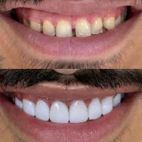 کامپوزیت اقساطی دندان پزشکی امور