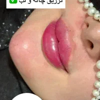 ژل،بوتاکس،مزوتراپی،مزونیدلینگ