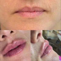 تزریق ژل و بوتاکس|خدمات آرایشگری و زیبایی|قم, صدوق|دیوار