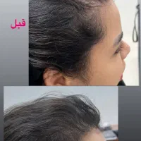 پاکسازی سر،موخوره گیری،اسکالپ،درمان ریزش،رویش مجدد|خدمات آرایشگری و زیبایی|قم, هفت تیر|دیوار