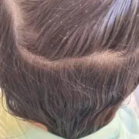 محلول ودستگاه پاکسازی رشکوشپش درگلبهاریک بارتضمینی