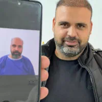 کاشت مو کاشت ابرو