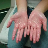 تزریق چربی به صورت و باسن و لابیا و بیکینی